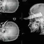 Mulher sobrevive após ter faca cravada na cabeça; suspeito é preso