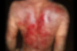 Adolescente com deficiência denuncia mãe após ser agredido com fios elétricos em Rondônia