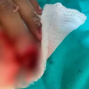 Mãe perde dedos ao tentar conter o próprio filho de agressões